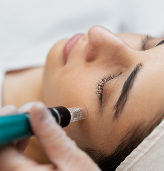 microneedling